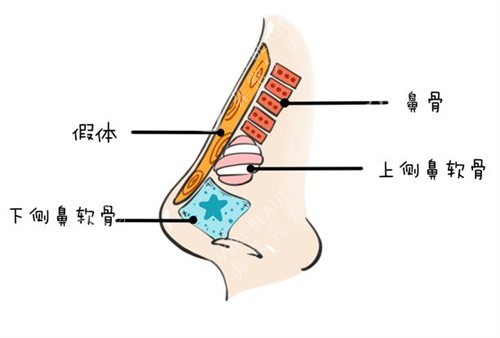 隆鼻假体图