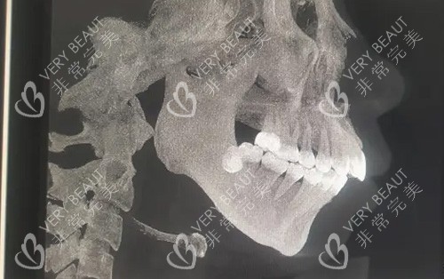 需要做正颌手术的骨骼图