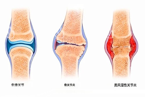 不同关节炎示意图