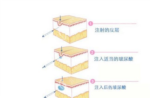 玻尿酸填充原理动画演示图