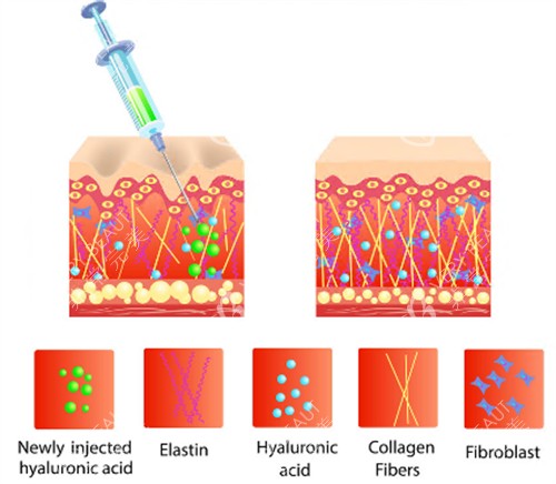 玻尿酸注射原理
