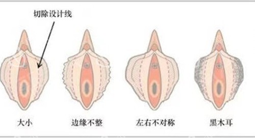 女性私密阴唇整形示意图