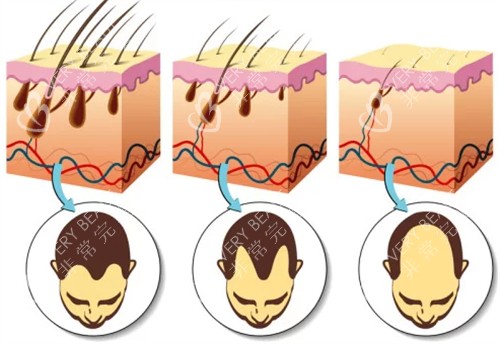 不同程度脱发的对比图解