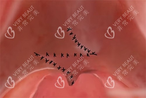 腭裂修复手术的缝合形状