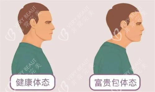健康体态和富贵包体态对比