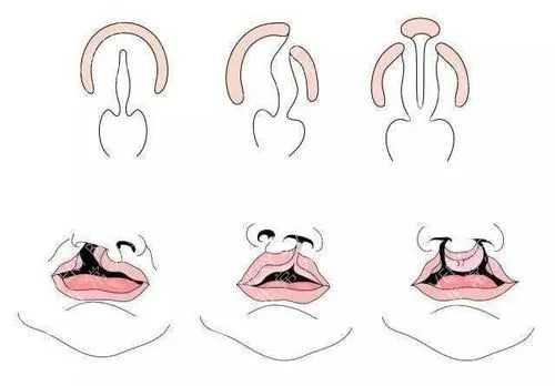 唇腭裂外形卡通示意图