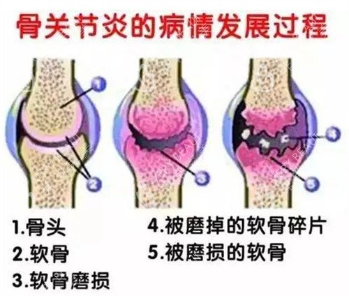 骨关节炎的病情发展过程