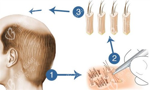 植发过程详细图解