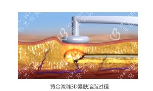 黄金微雕示意图