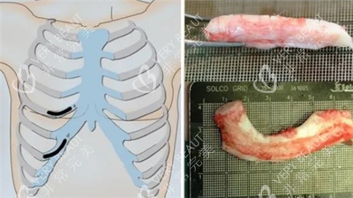 肋骨隆鼻细节图