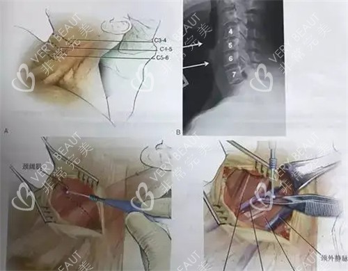 颈阔肌成形术手术过程介绍