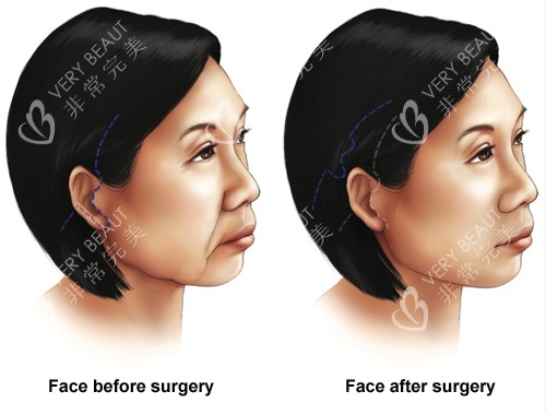 面部提升手术前后对比图