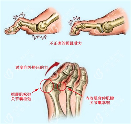 引起大脚骨的原因