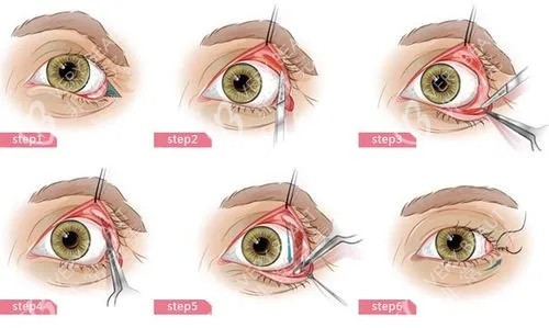 内切法眼整形卡通示意图