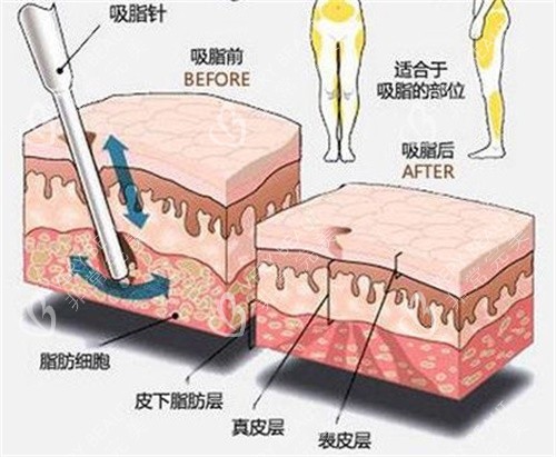 吸脂原理示意图