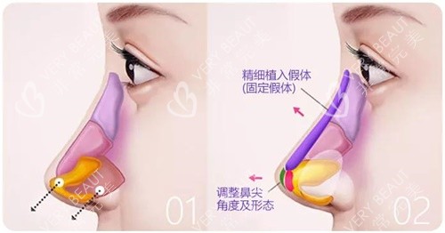 郝亚宁鼻综合示意图
