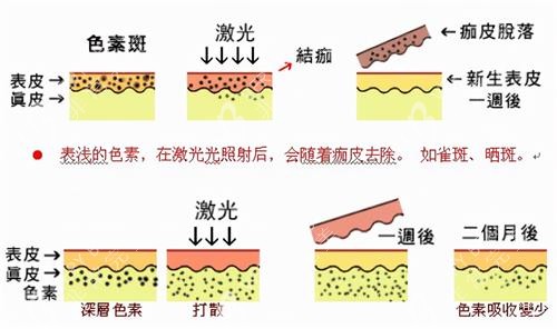 激光祛斑后的变化