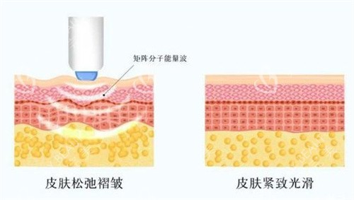 紧致肌肤前后对比