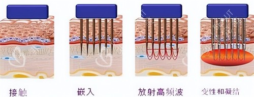 黄金微针操作过程