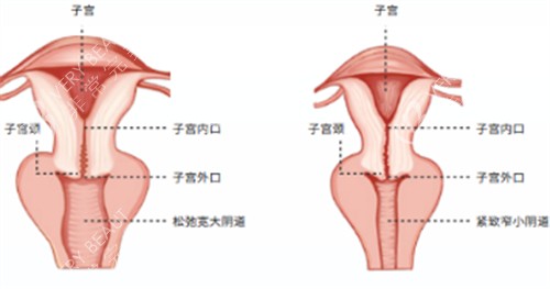 阴道紧缩术施术位置图解