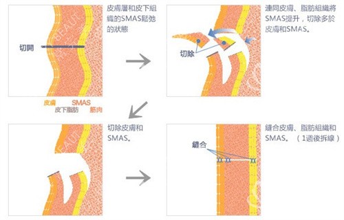 筋膜提升术宣传图