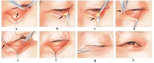 去眼袋手术方法