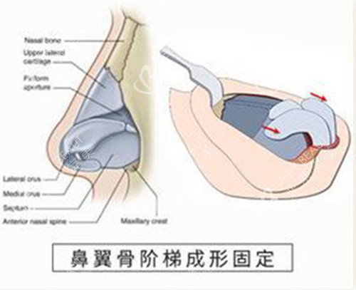 鼻翼骨阶梯成形固定