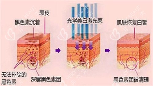 光子嫩肤原理