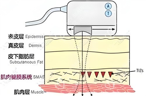 热拉提作用皮肤层