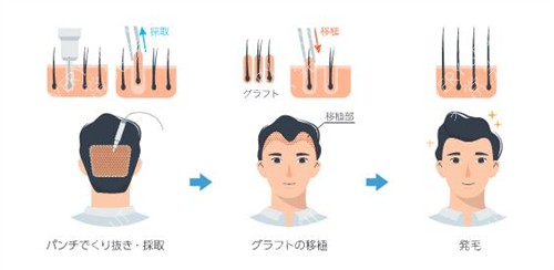 日本Saisei免疫干细胞治疗中心植发