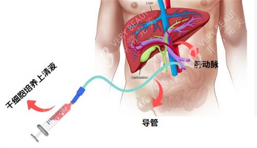 日本Saisei免疫干细胞治疗肝脏