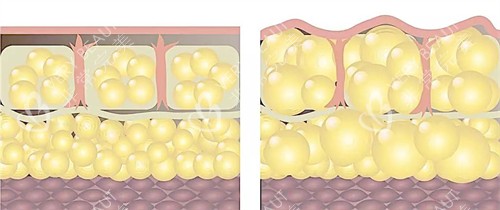 自体脂肪填充前后皮肤层动画图