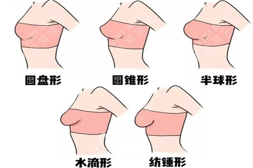 王世虎医生给出多种胸型选择
