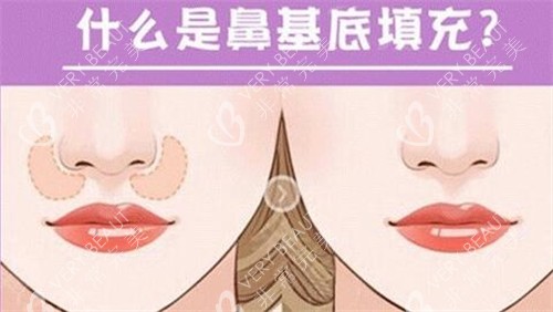 什么是鼻基底填充