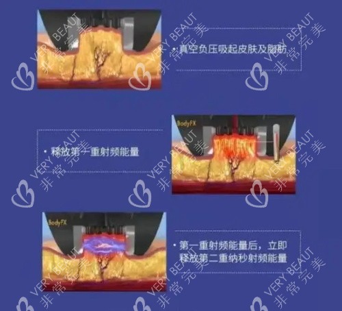 钻石超塑整形的优势示意图