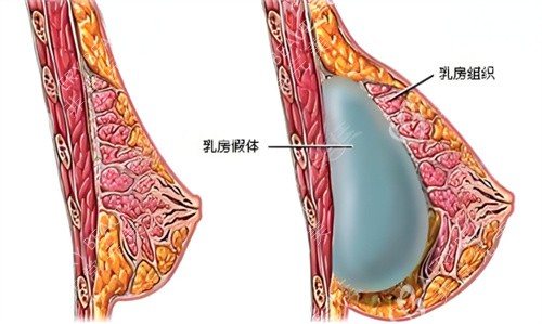 假体隆胸术原理图