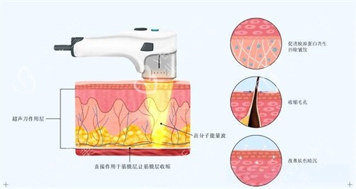 面部除皱热玛吉方式原理演示图