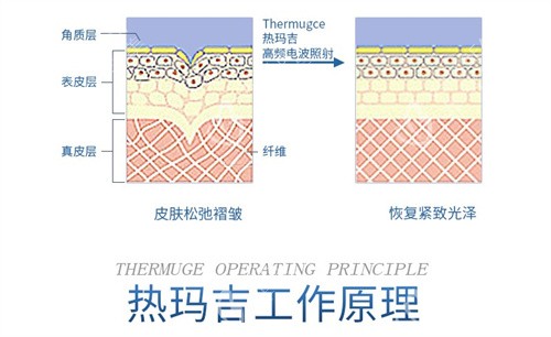 热玛吉工作示意图