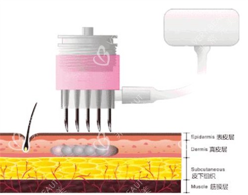 微针可以达到的肌肤层次图解