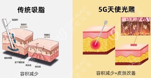 5G天使光雕对比传统吸脂