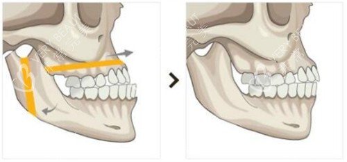 双鄂手术前后对比