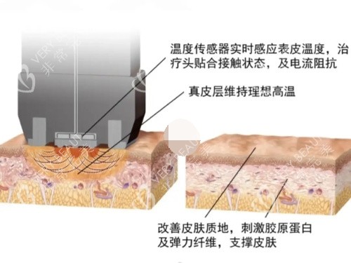 钻石超塑整形原理示意图