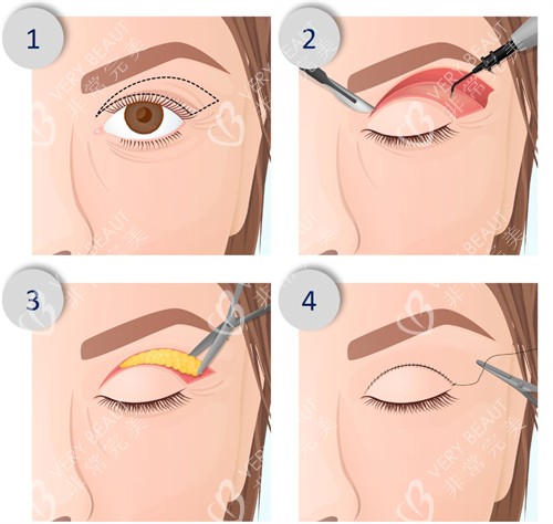 切开型双眼皮手术过程