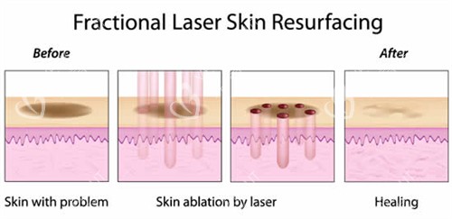 激光祛斑流程图