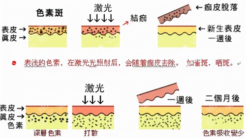 激光祛斑过程