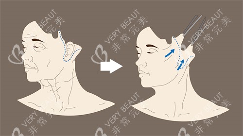 面部拉皮方式动画演示图