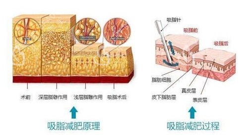 吸脂减肥原理