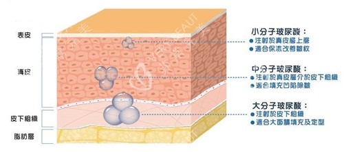 玻尿酸填充层次