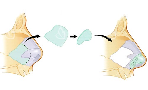 假体隆鼻简易过程示意图
