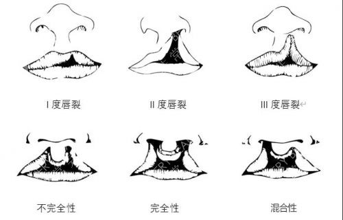 唇腭裂图片)